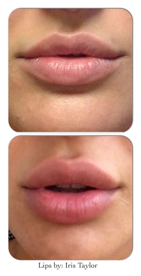 Mybodytonic Botox Lips Lip Fillers Lip Fillers Juvederm