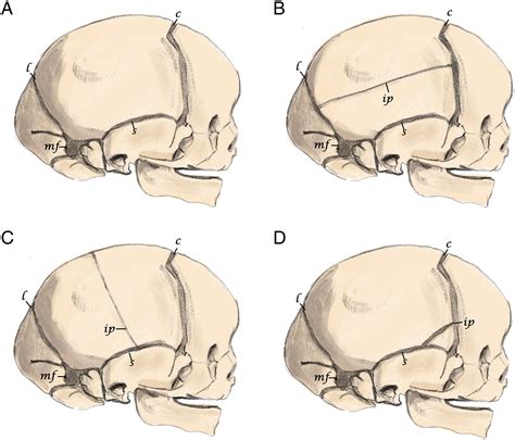 Atypical Accessory Intraparietal Sutures Mimicking Complex Fractures In