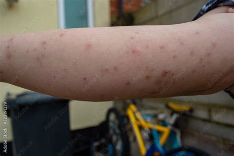 Bed Bug Bites Swelling And Scars In Multiple Locations On The Skin Of A Females Arm From A
