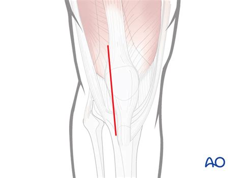 Lateral Parapatellar Approach To The Distal Femur
