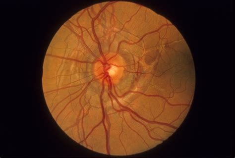 Pseudoxanthoma Elasticum Hereditary Ocular Diseases