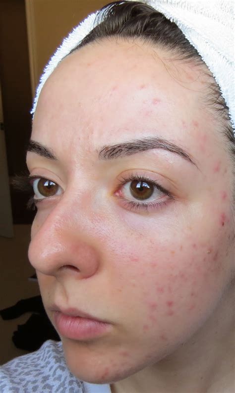 My Skins Journey Week 40 Banish Acne Scars