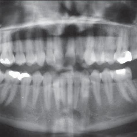 Pdf Autotransplantation Of An Impacted Third Molar An Orthodontic