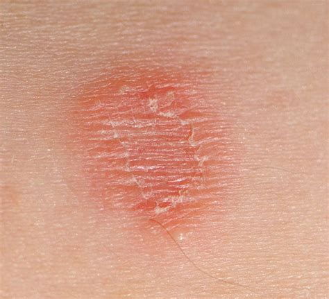 Skin Lesions Pictures Treatments And Causes