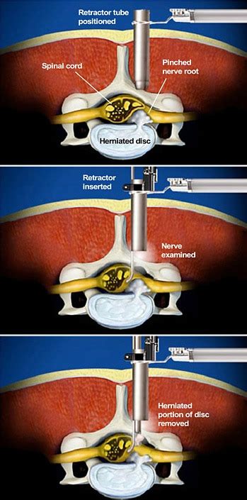 Micro Endoscopic Posterior Cervical Discectomy The Southeastern Spine Institute