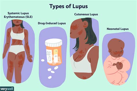 Lupus Overview And More