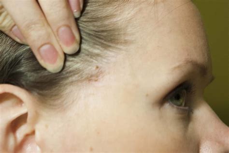Высыпания на коже головы причины и лечение высыпаний на голове