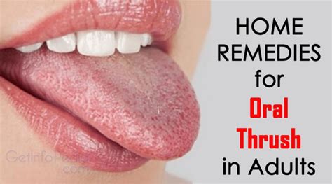 Home Remedies For Oral Thrush In Adults Get Complete Information