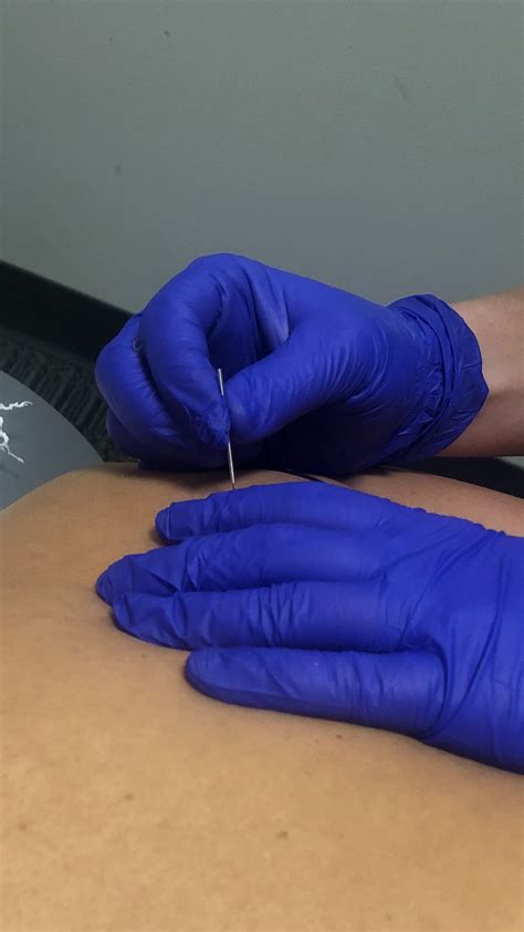 Lakeshore Physical Therapy Getting To The Point All About Dry Needling