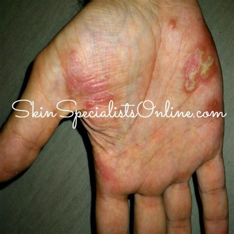 Ask A Skin Doctor Infected Hand Eczema Skin Specialists Online