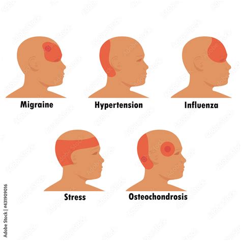 Vetor Do Stock Types Of Headaches Schematic Representation Of Foci Of Headache In Stress Flu