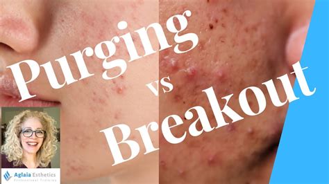 Purging Vs Breakouts What Is The Difference Youtube