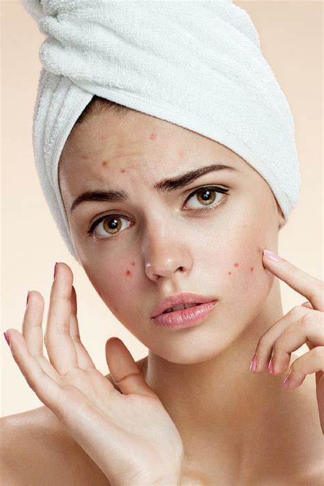 Beauty Tips Pimples