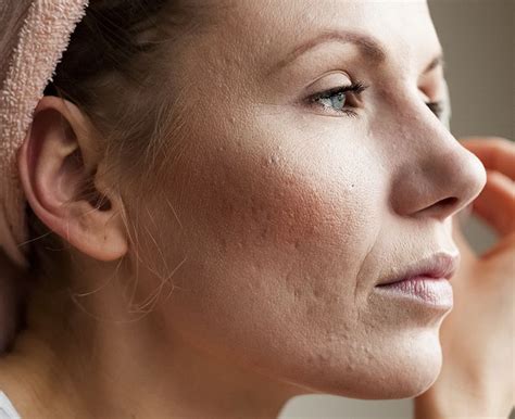 Scheitel Auswandern verkürzen tratament cu laser pentru semne acnee
