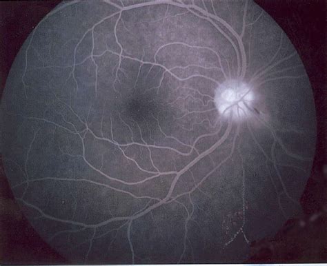 Diagnostics Retina Specialists Huntington Beach 92647