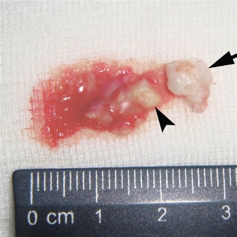 Arrow Indicates A Punctum Ie Keratin Filled Orifice Of The Cyst In A