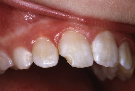 32 Year Follow Up Of A Class Iv Central Incisor Restoration Page 1