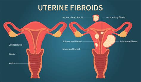 Small Fibroid In Uterus Presentation