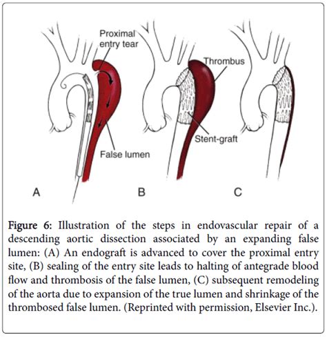 Emergency Medicine Illustration Steps Aortic