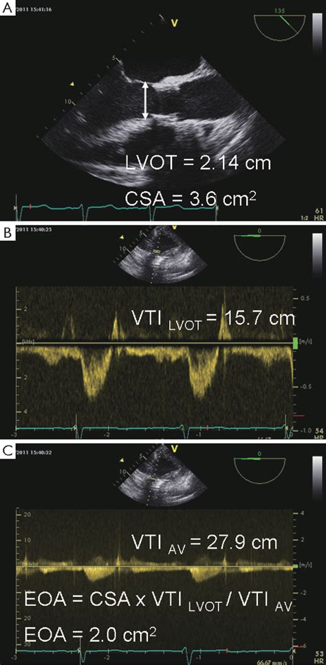 Figure 1 From Patient Prosthesis Mismatch After Transapical Aortic