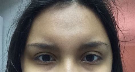 Weird Forehead Swelling Frontal Sinusitis Or Something Else Raskdocs