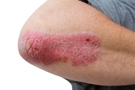 Psoriasis On A Mid Age Mans Elbow Stock Photo Download Image Now Istock