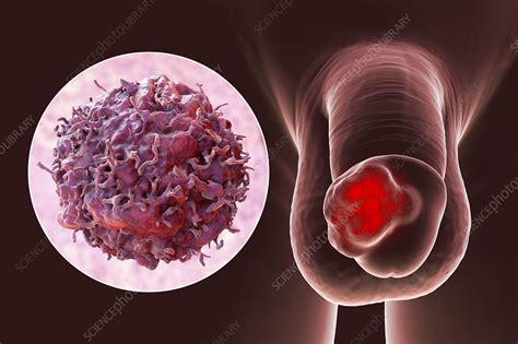 Penile Cancer Illustration Stock Image F034 7633 Science Photo Library