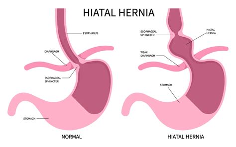 Hiatal Hernia Symptoms Treatment Aurora Health Care