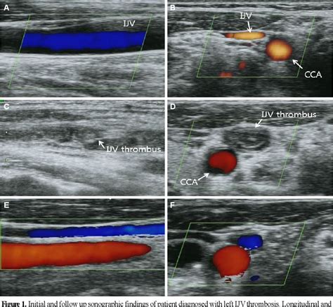 Figure 1 From Sonographic Follow Up Finding Of Internal Jugular Vein