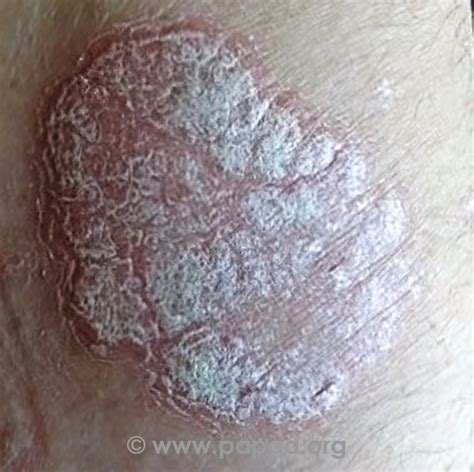 Types Of Psoriasis Who Gets It How They Are Affected And What To Expect