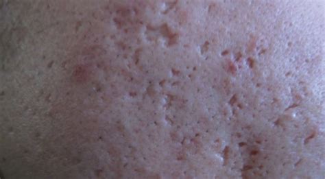 Shoulder And Back Acne Scars Best Treatments Skincarederm