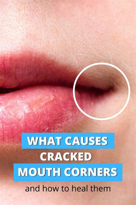 What Causes Cracked Lip Corners And How To Heal Them Cracked Corners