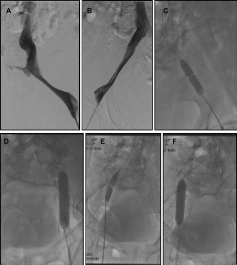 Intervention For Iliofemoral Deep Vein Thrombosis And May Thurner