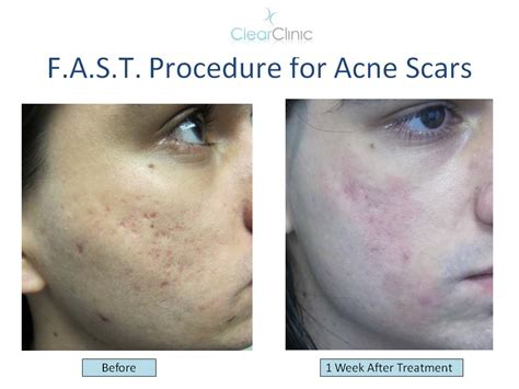 Fast Scar Treatment Clear Clinic Acne And Acne Scar