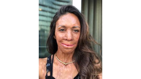 The Intimate Family Pictures Of Turia Pitt Before The Fire That Almost Took Her Life Oversixty