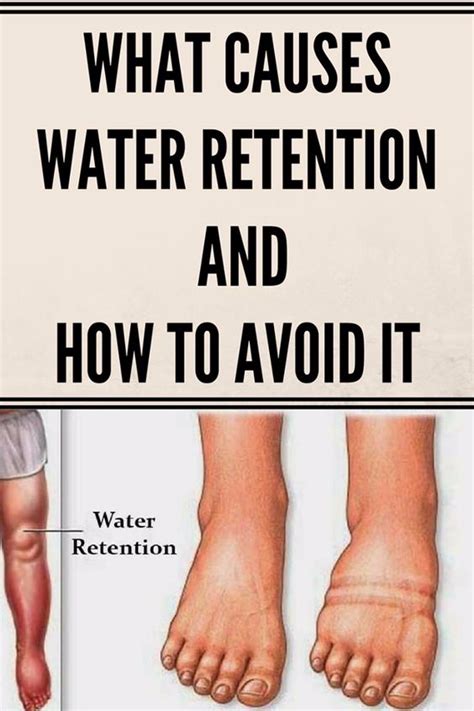 What Causes Water Retention And How To Avoid It Health Blog