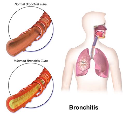 Diferencia Entre Bronquitis Y Bronquiolitis Enfermedad