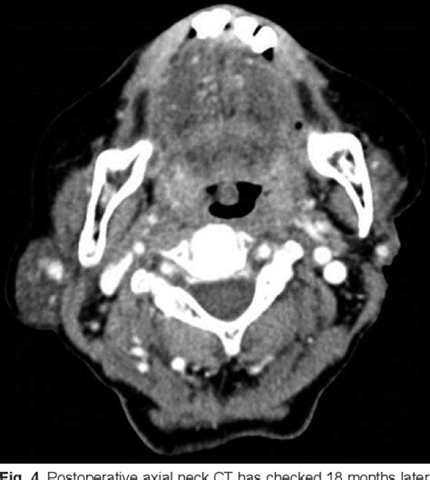 Figure 4 From A Case Of Giant Carcinosarcoma Of The Parotid Gland