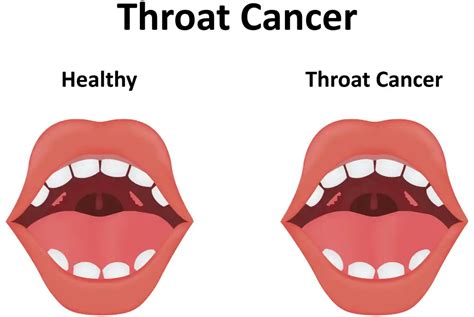 Throat Cancer Causes Symptoms And Treatments Soundproof Talk