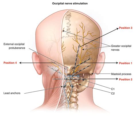 Occipital Nerve Stimulator Pain Management Clinics In Las Vegas