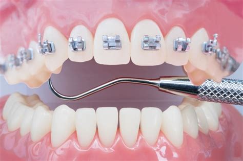 Premium Photo Orthodontic Model And Dentist Tool Demonstration Teeth Model Of Varities Of
