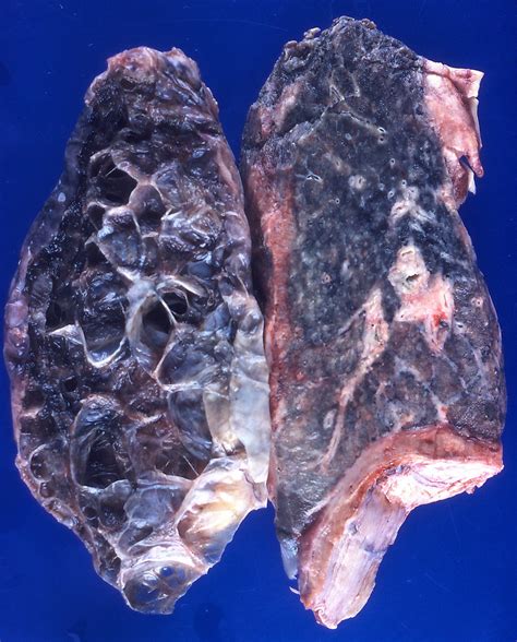 Bullous Emphysema The Lung On The Left Is Almost Entirely Flickr