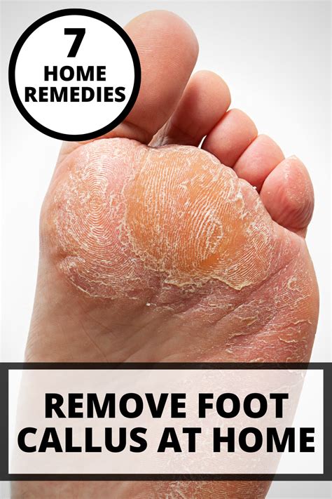 How To Remove Foot Callus At Home In 2021 Foot Callus Foot Remedies