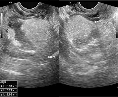 Dermoid Cyst Ultrasound Wikidoc