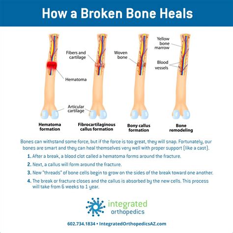 How Does A Broken Bone Heal Integrated Orthopedics