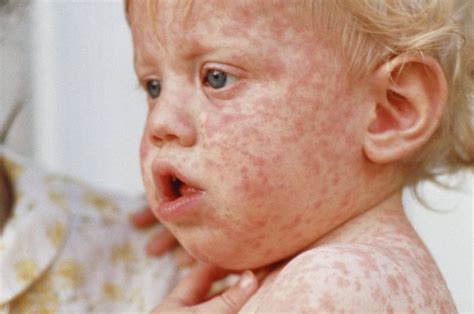 Germany Vaccination Fines Plan As Measles Cases Rise Bbc News