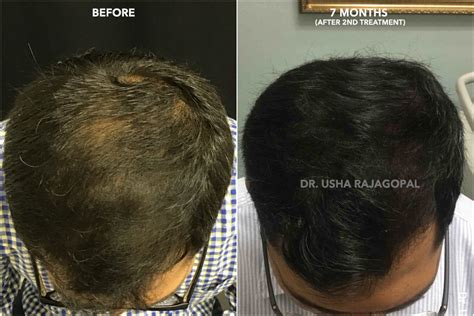 hair regrowth therapy with acell prp san francisco bay area usha rajagopal md