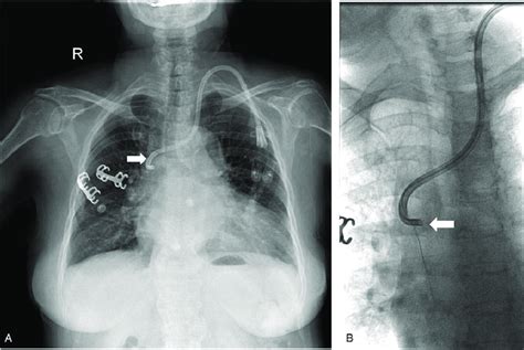 Analysis Of Catheter Tip Malposition A Chest Radiograph Showing