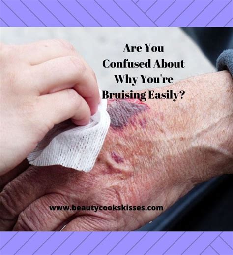Reasons For Bruising Easily That You Should Know Beauty Cooks Kisses
