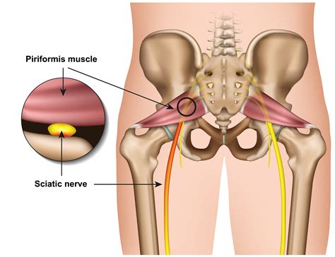 Fix Piriformis Syndrome With Resistance Bands